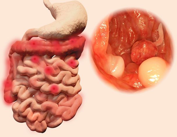 结肠肿瘤晚期症状表现