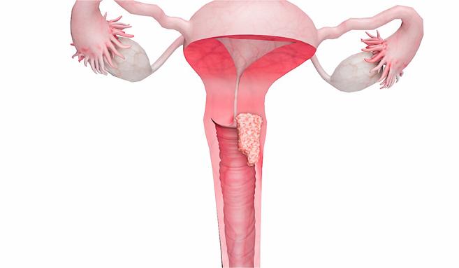 1723712261150345.jpg 摄图网_402174406_wx_子宫颈癌二期(企业商用).jpg